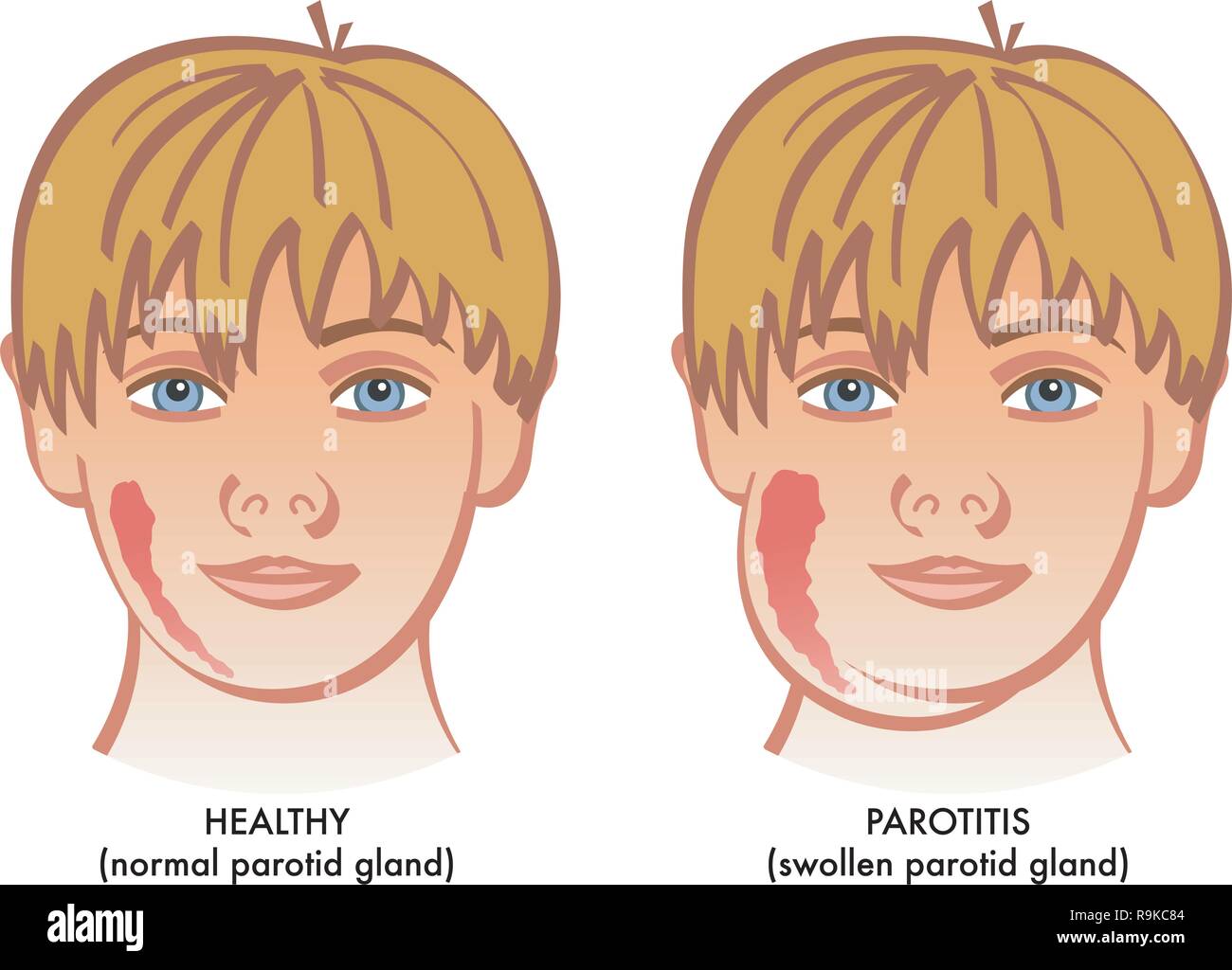 A vector medical illustration showing a healthy child next to on suffering from parotitis or inflammation of parotid glands. Stock Vector