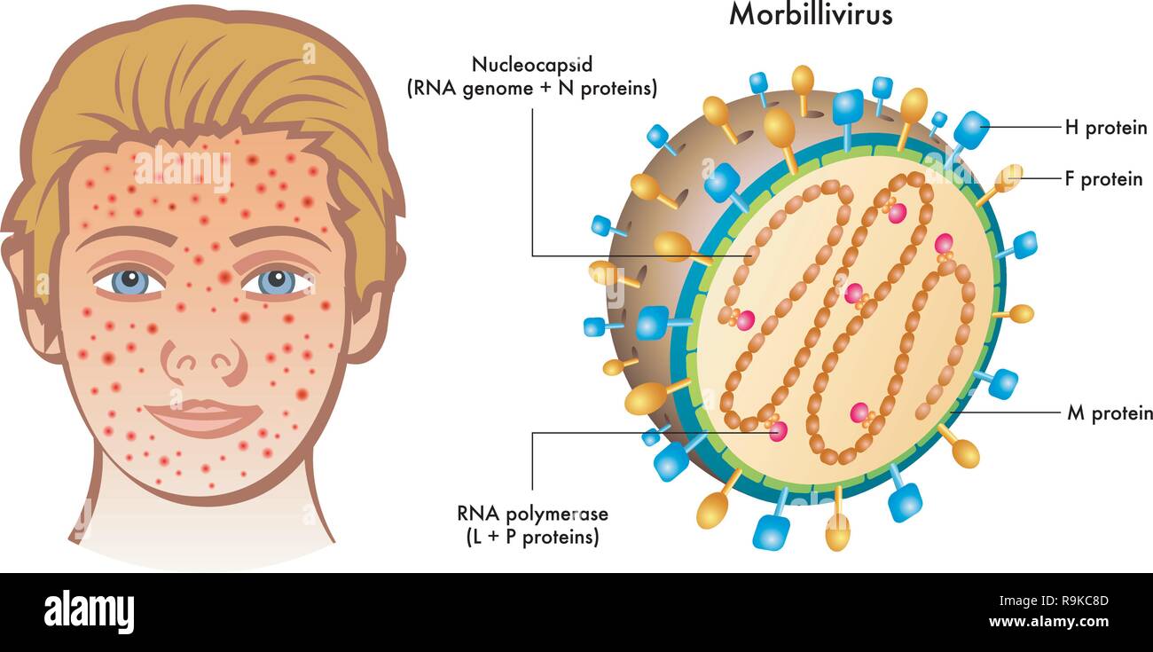 Cutaway labelled diagram of Morbillivirus with illustration of boy showing symptoms on face, white background. Stock Vector