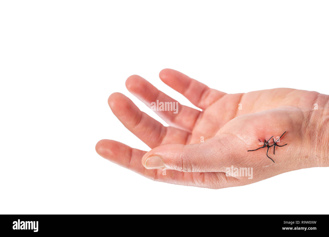 Caucasian left hand with 3 stitches over white background Stock Photo