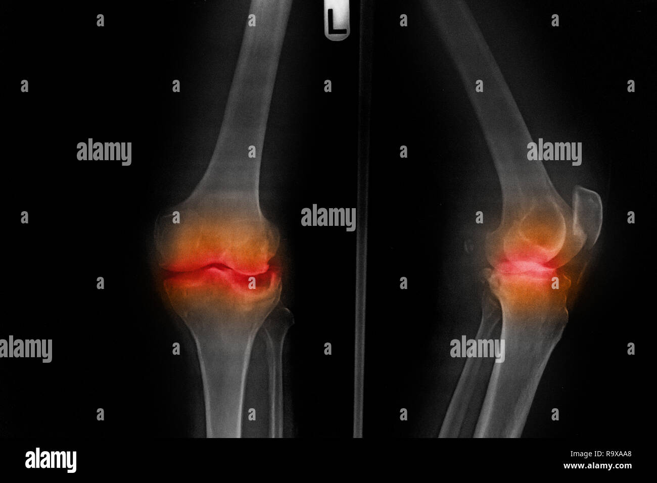 Osteoarthritis Left knee film x-ray AP (anterior - posterior) of knee show narrow joint space . Stock Photo