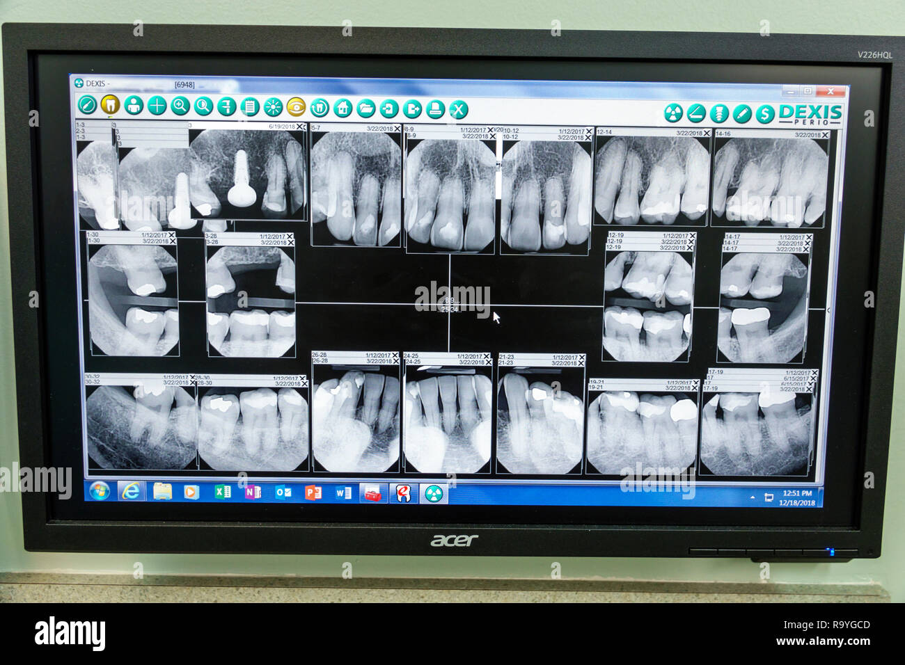 Miami Beach Florida,xrays x-rays,teeth mouth fillings implant crown,dentist periodontist office examination room,FL181222024 Stock Photo