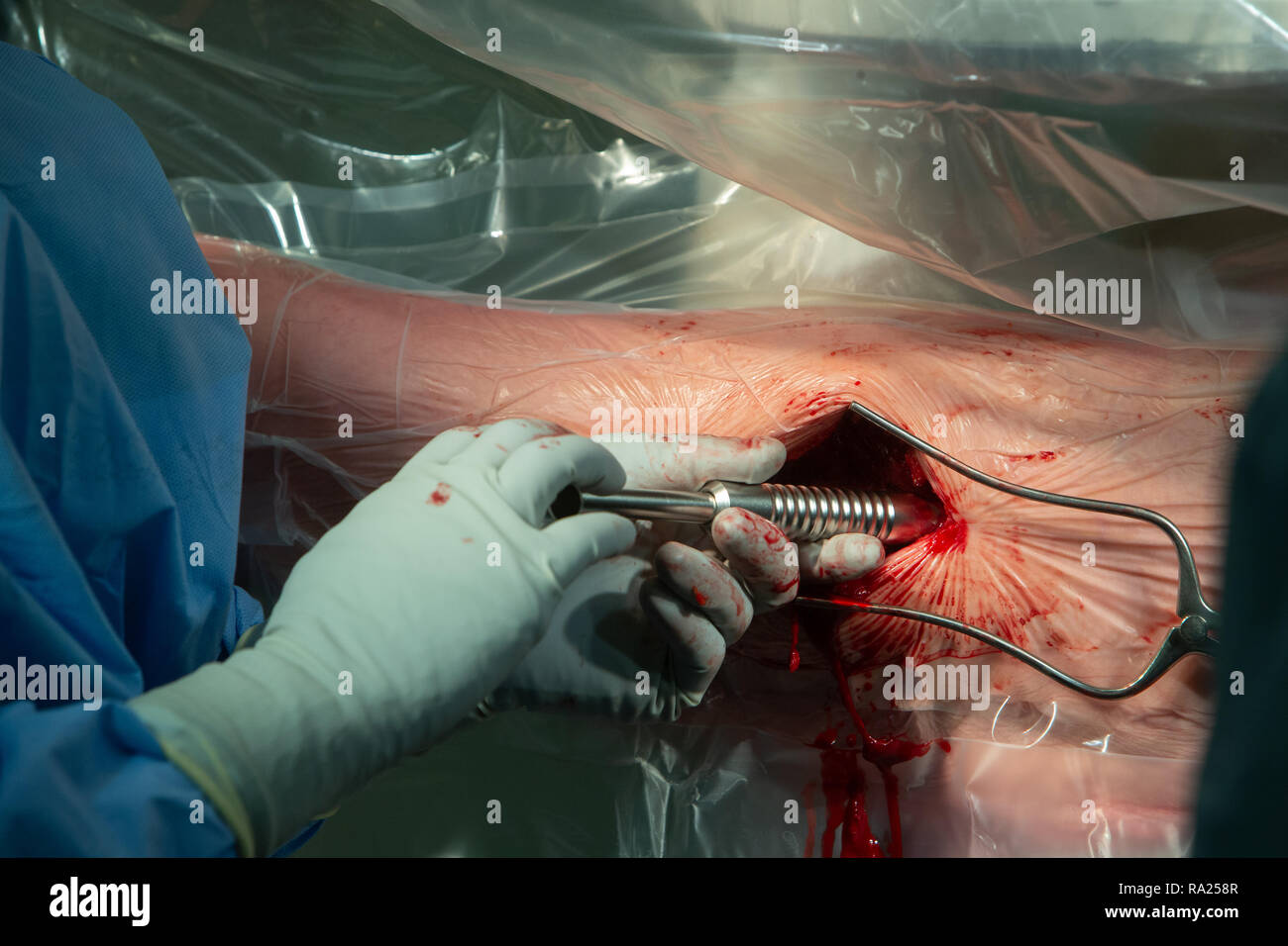 A Surgeon tightens a screw during a hip replacement operation at an NHS hospital. Stock Photo