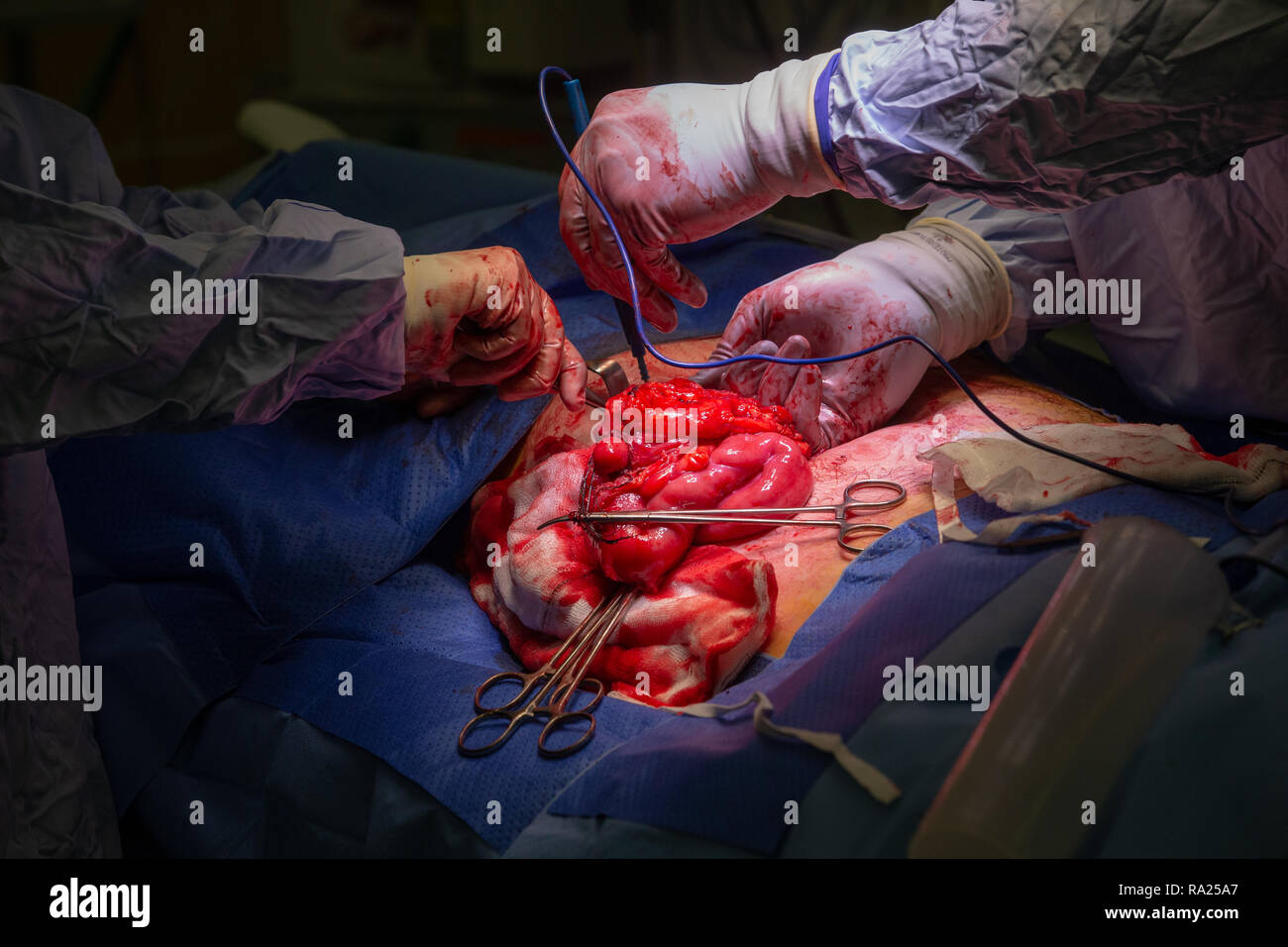 Surgeons perform surgery to remove tumour in the intestines of the stomach. The surgery is necessary to unblock the intestines. Stock Photo