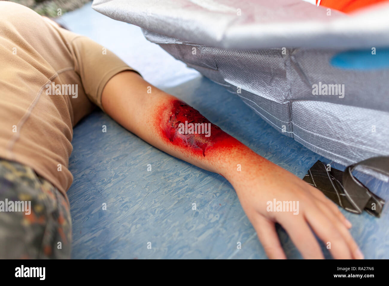 first aid bandage on burnt wound victim Stock Photo