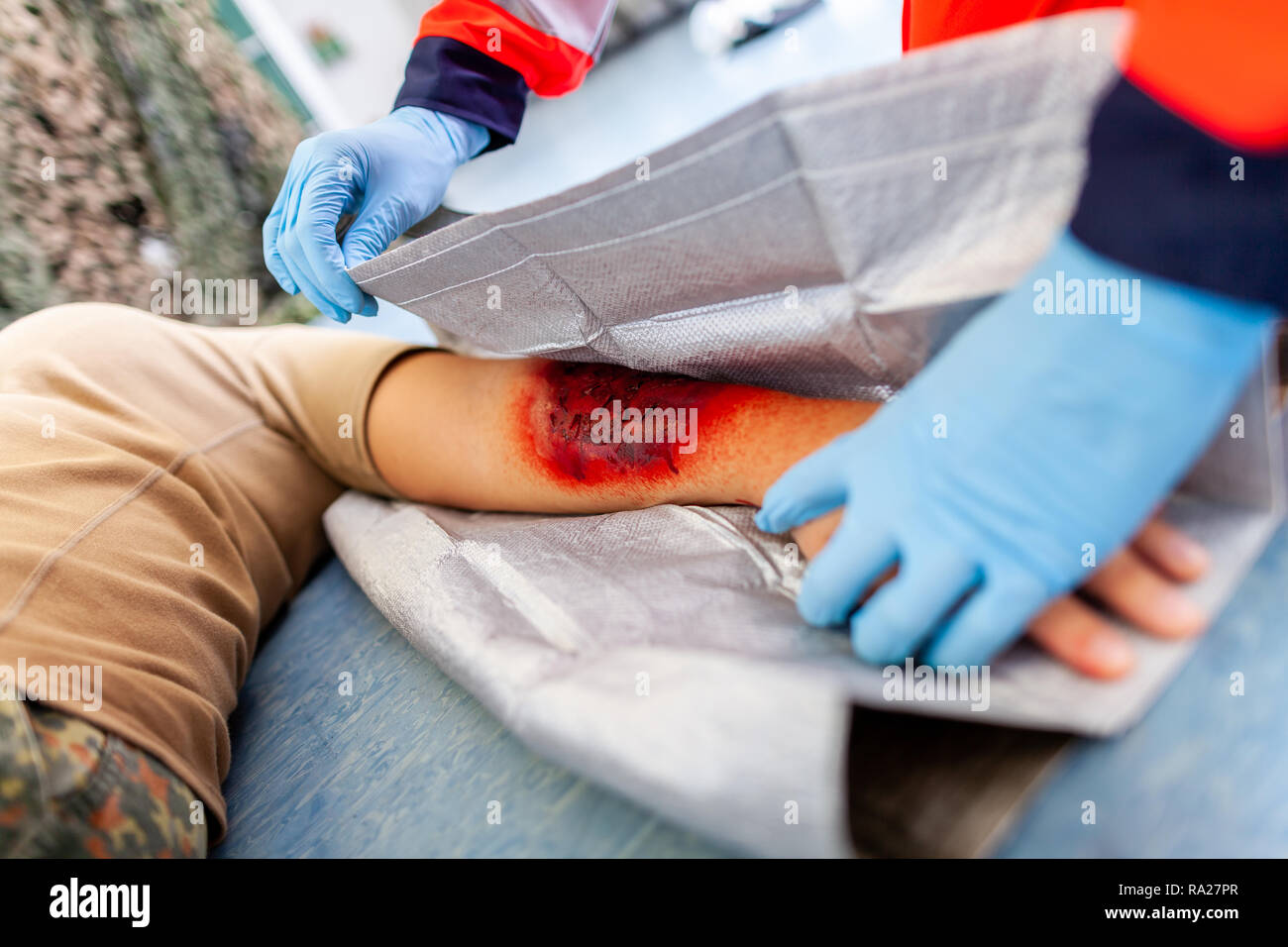 first aid bandage on burnt wound victim Stock Photo