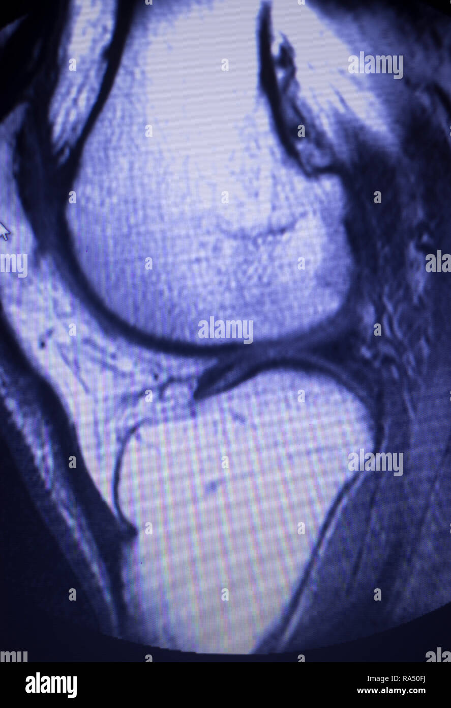resonance imaging MRI knee posterior horn medial meniscus tear