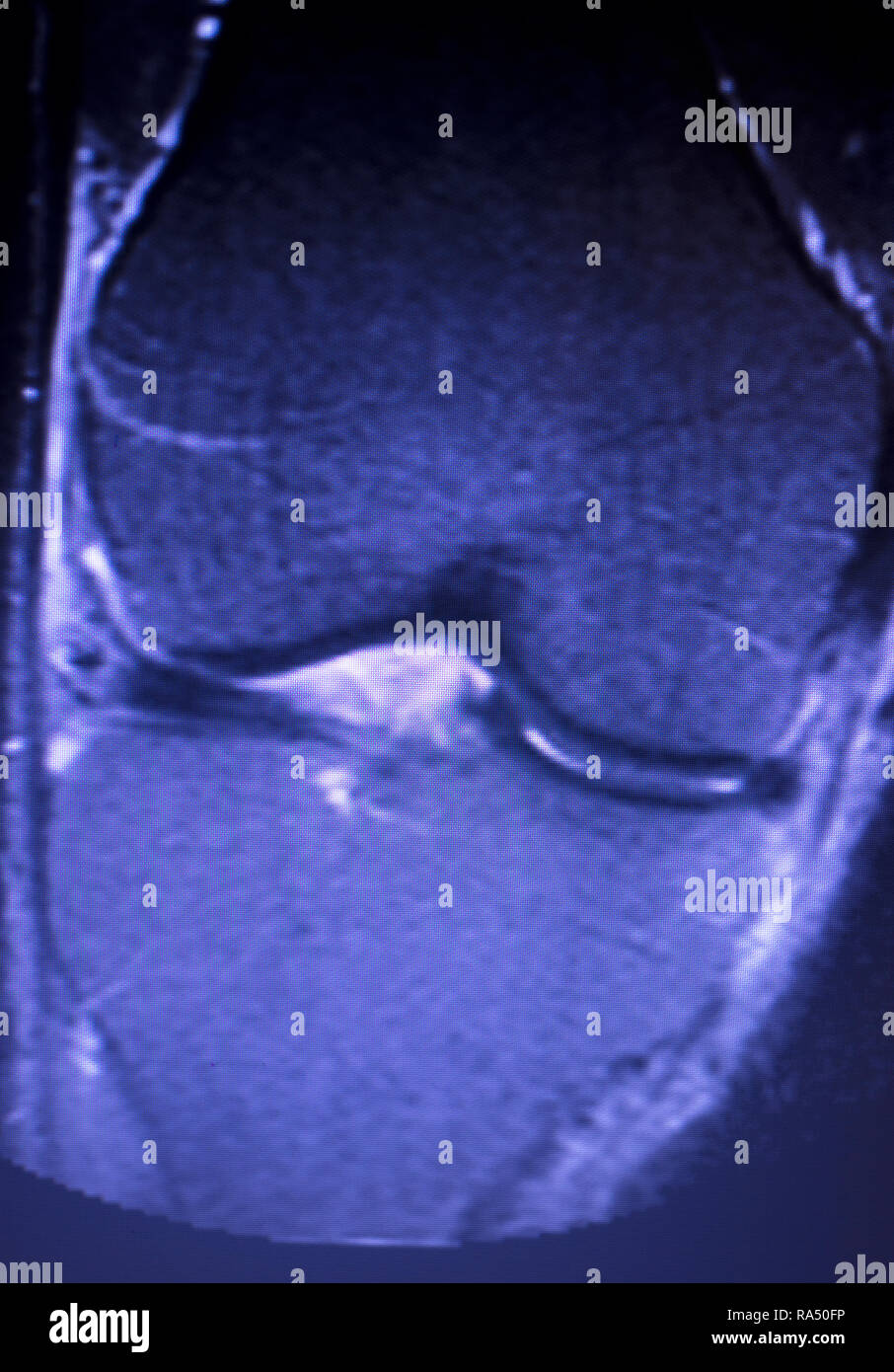 Magnetic resonance imaging MRI knee posterior horn medial meniscus tear ...