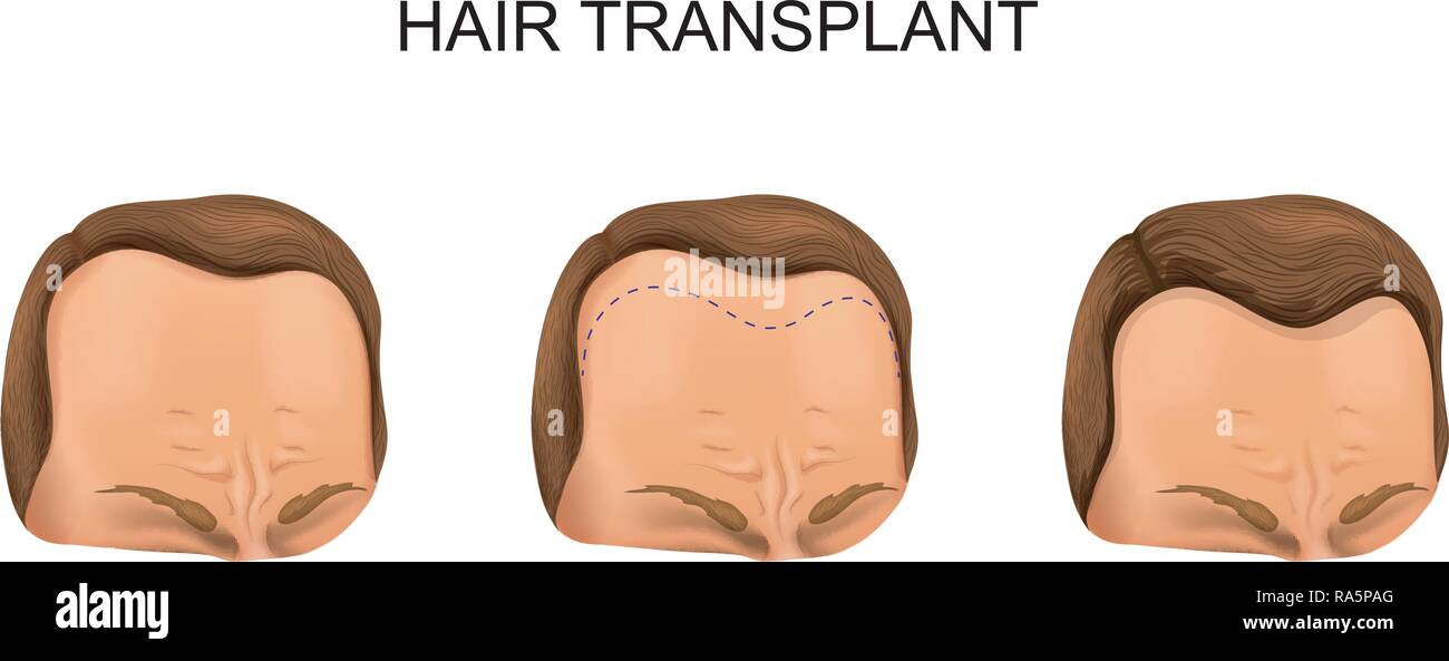 vector illustration of a man's hair transplant Stock Vector
