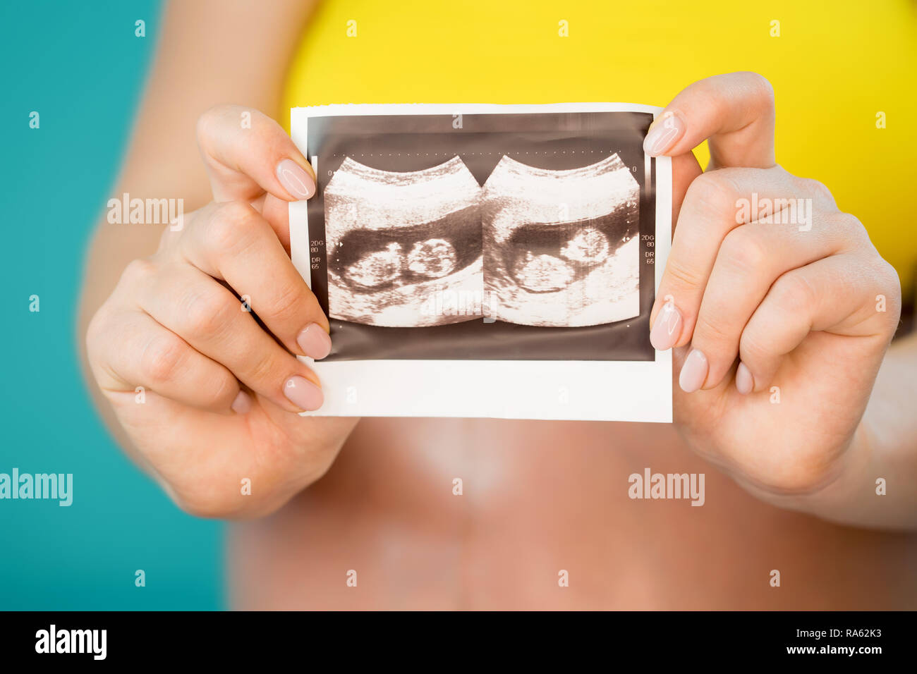 Close-up of unrecognizable pregnant woman holding ultrasound scan on her belly background. Maternity, motherhood, pregnancy, love, twins concept. Stock Photo