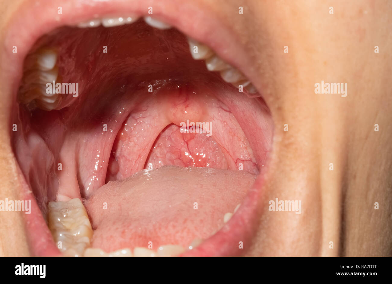 Sore throat with throat swollen. Closeup open mouth with posterior pharyngeal wall swelling and uvula and tonsil. Influenza follicles in the posterior Stock Photo