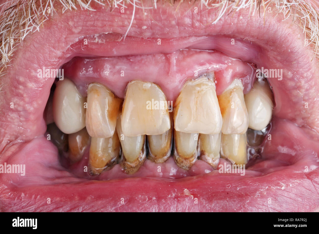 Tooth decay tobacco hires stock photography and images Alamy