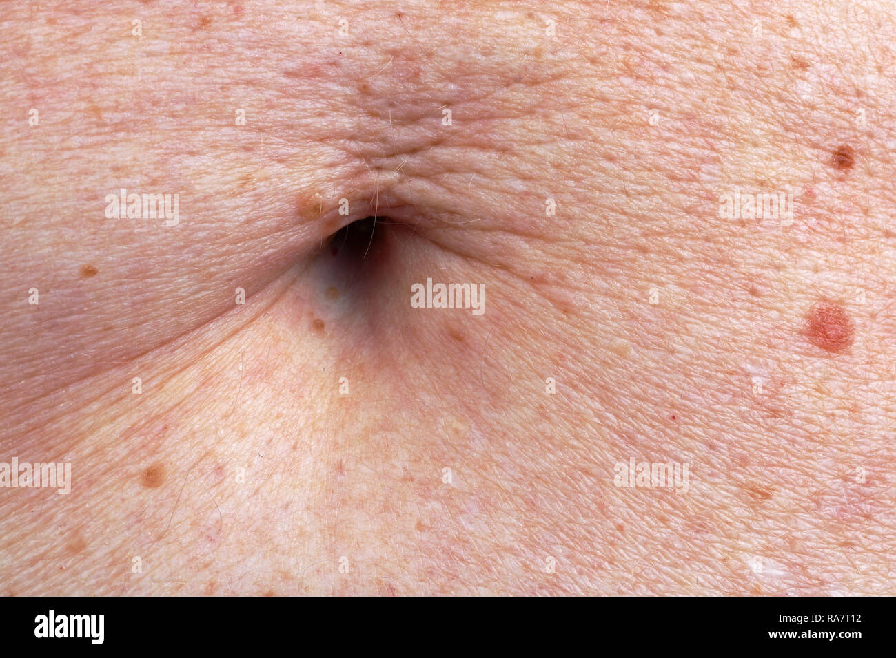 The surface of the stomach skin and navel of the elderly old woman. A lot of moles, blemishes and scars from cut off warts. Studio macro shot Stock Photo