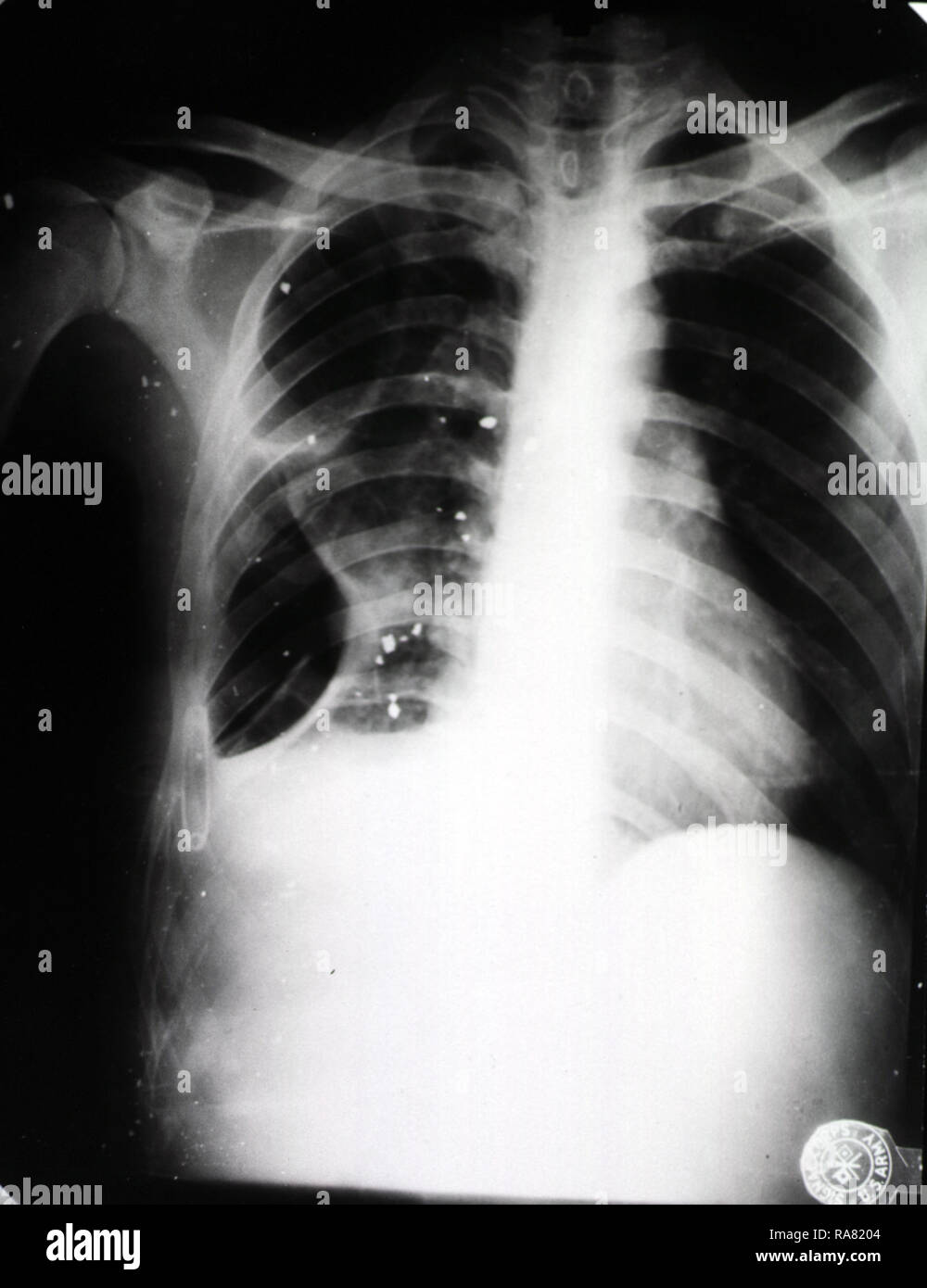 Chest Wound High Resolution Stock Photography and Images Alamy