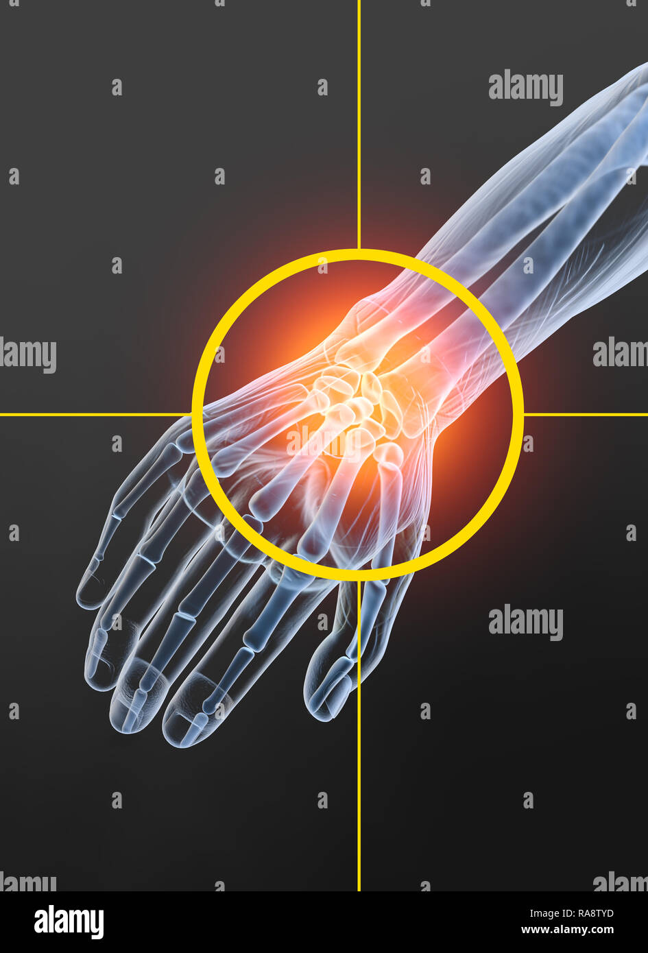 Rheumatoid arthritis wrist joint, medically 3D illustraion Stock Photo