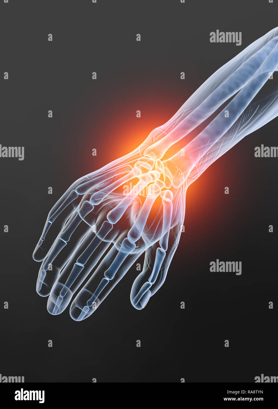 Rheumatoid arthritis wrist joint, medically 3D illustration Stock Photo