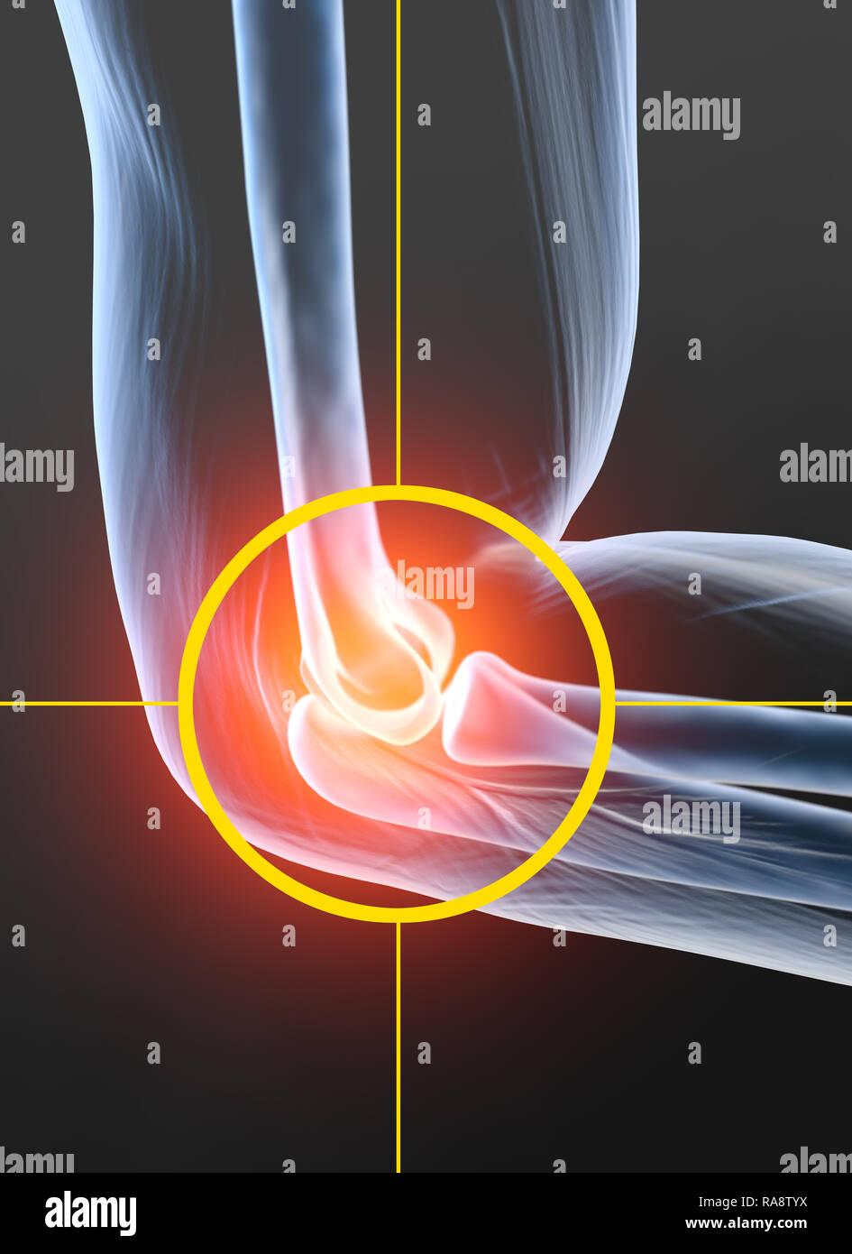 Painful elbow joint, medically 3D illustration Stock Photo Alamy