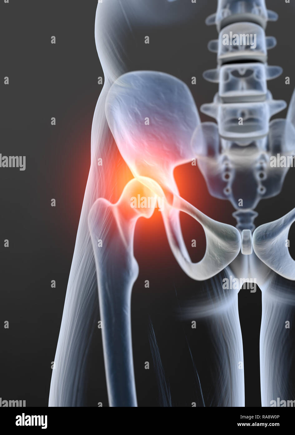 Hip osteoarthritis x ray hires stock photography and images Alamy