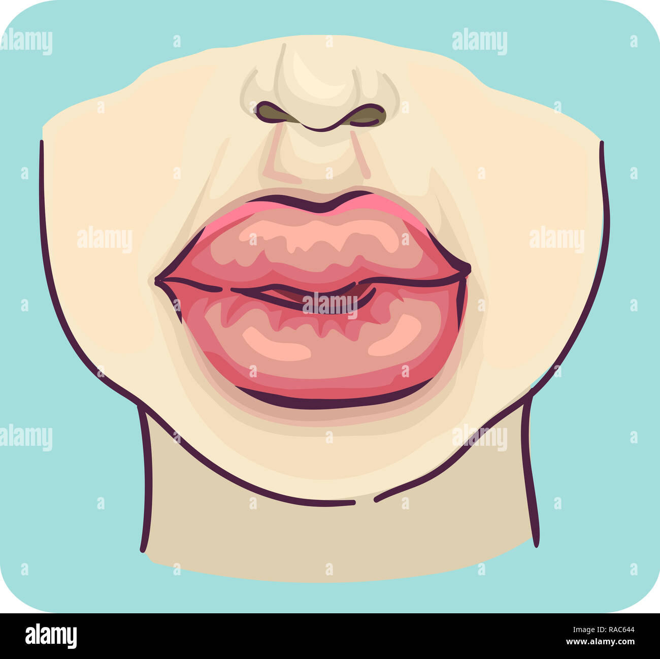 Illustration of a Man and Woman with Swollen Lips Stock Photo Alamy