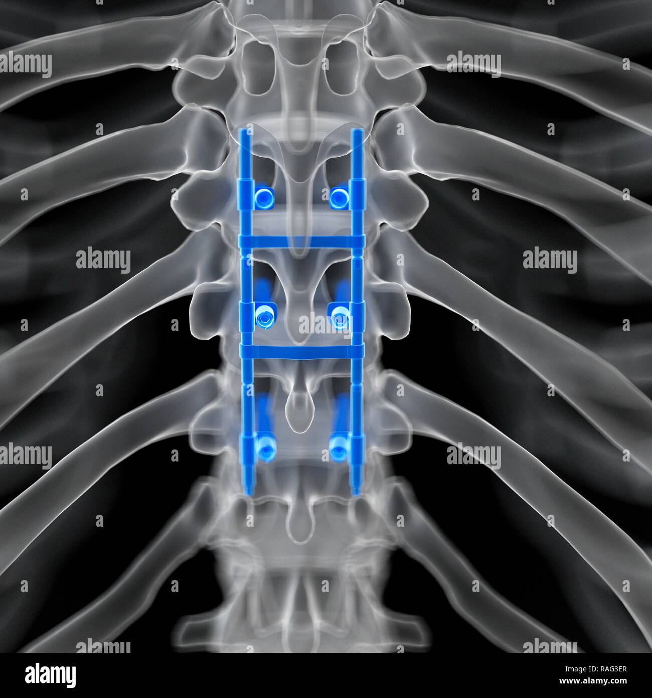 Illustration Of A Spinal Fusion Stock Photo Alamy