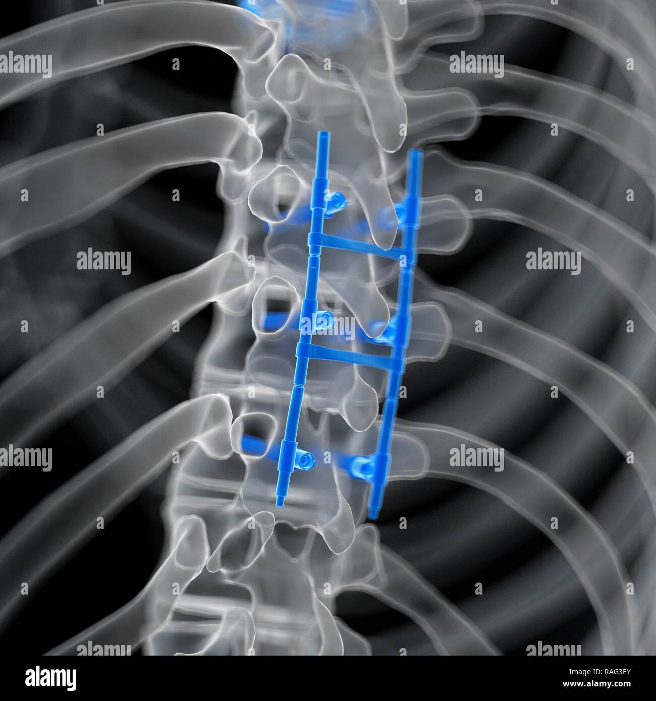 Illustration of a spinal fusion Stock Photo Alamy
