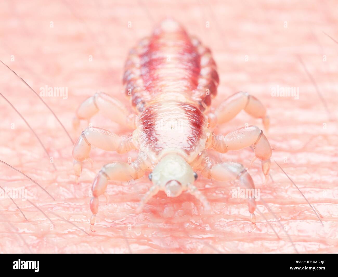 Illustration of a head louse on human skin. Stock Photo