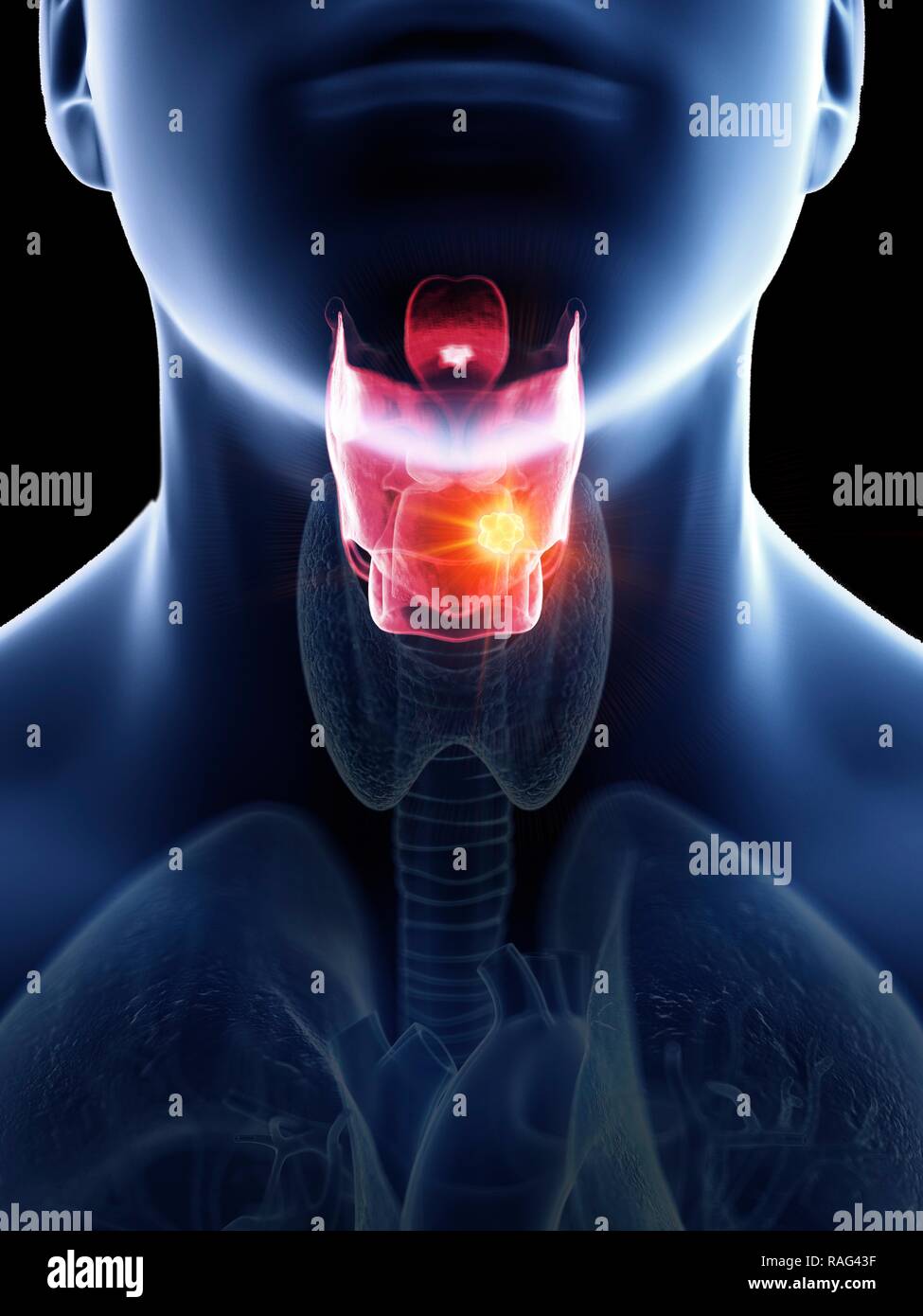 Illustration of a man's larynx cancer Stock Photo - Alamy