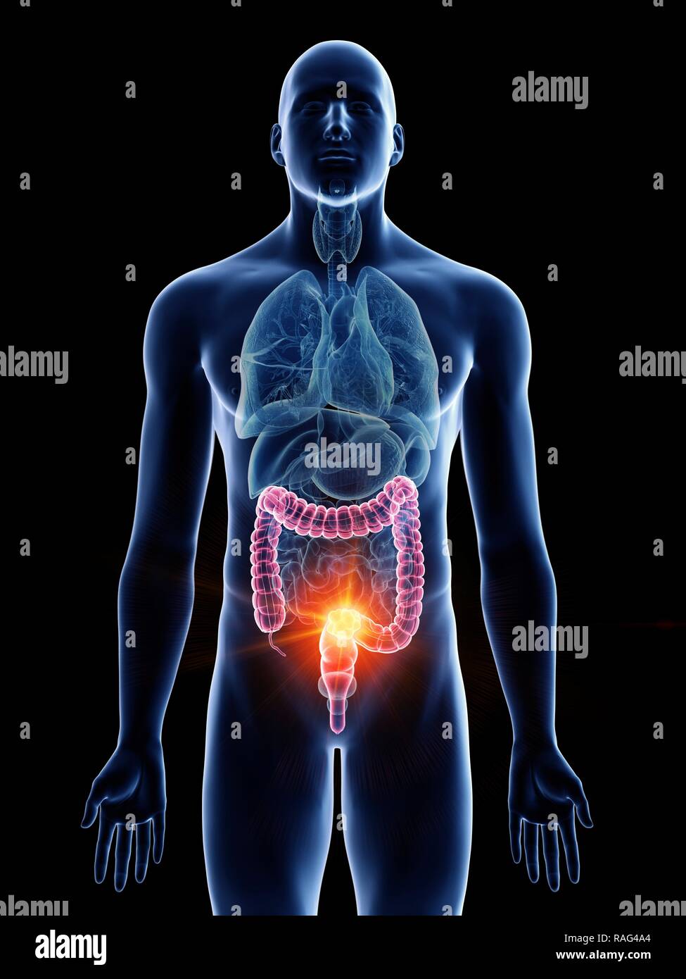 Illustration of a man's colon cancer Stock Photo - Alamy