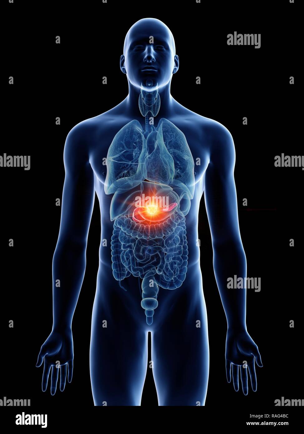 Illustration of a man's pancreas cancer Stock Photo - Alamy