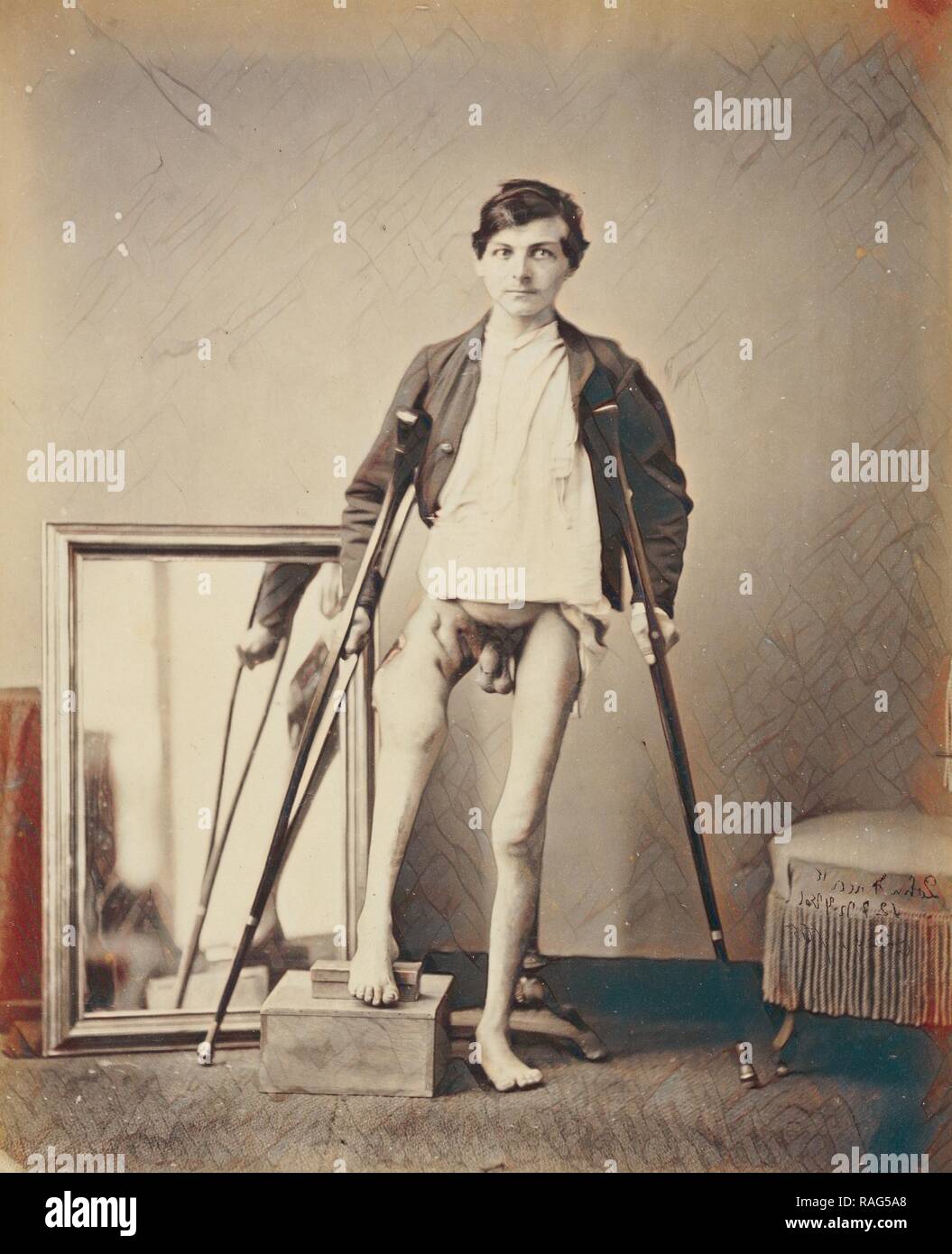 Gunshot Fracture of the Shaft of the Right Femur, United with Great Shortening and Deformity