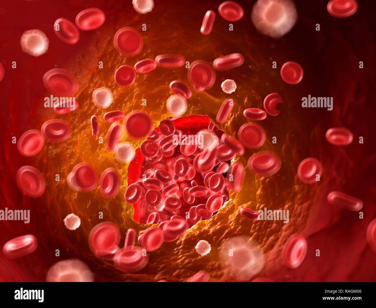 Illustration of a blocked artery. Stock Photo