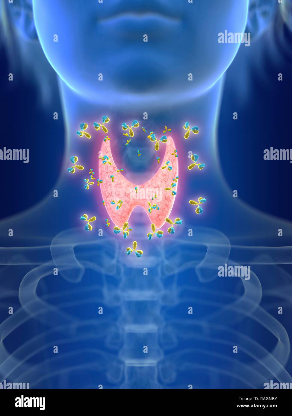 Illustration of an inflamed thyroid gland being attacked by antibodies