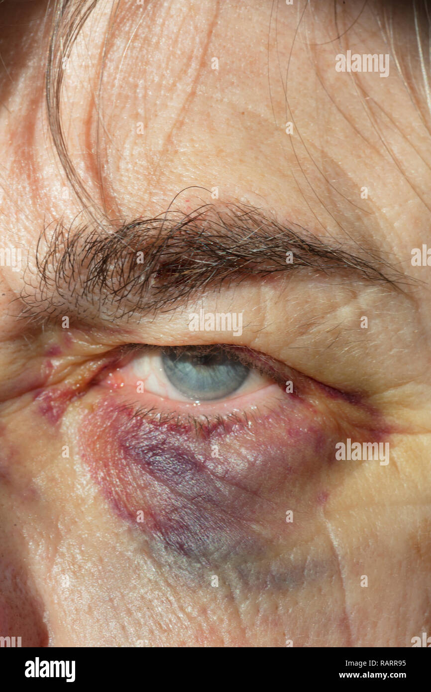 Woman with a black eye. Stock Photo