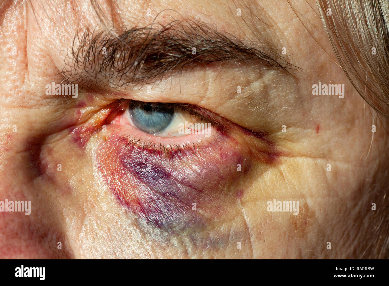 Black eye facial injury on the face of a woman. Stock Photo