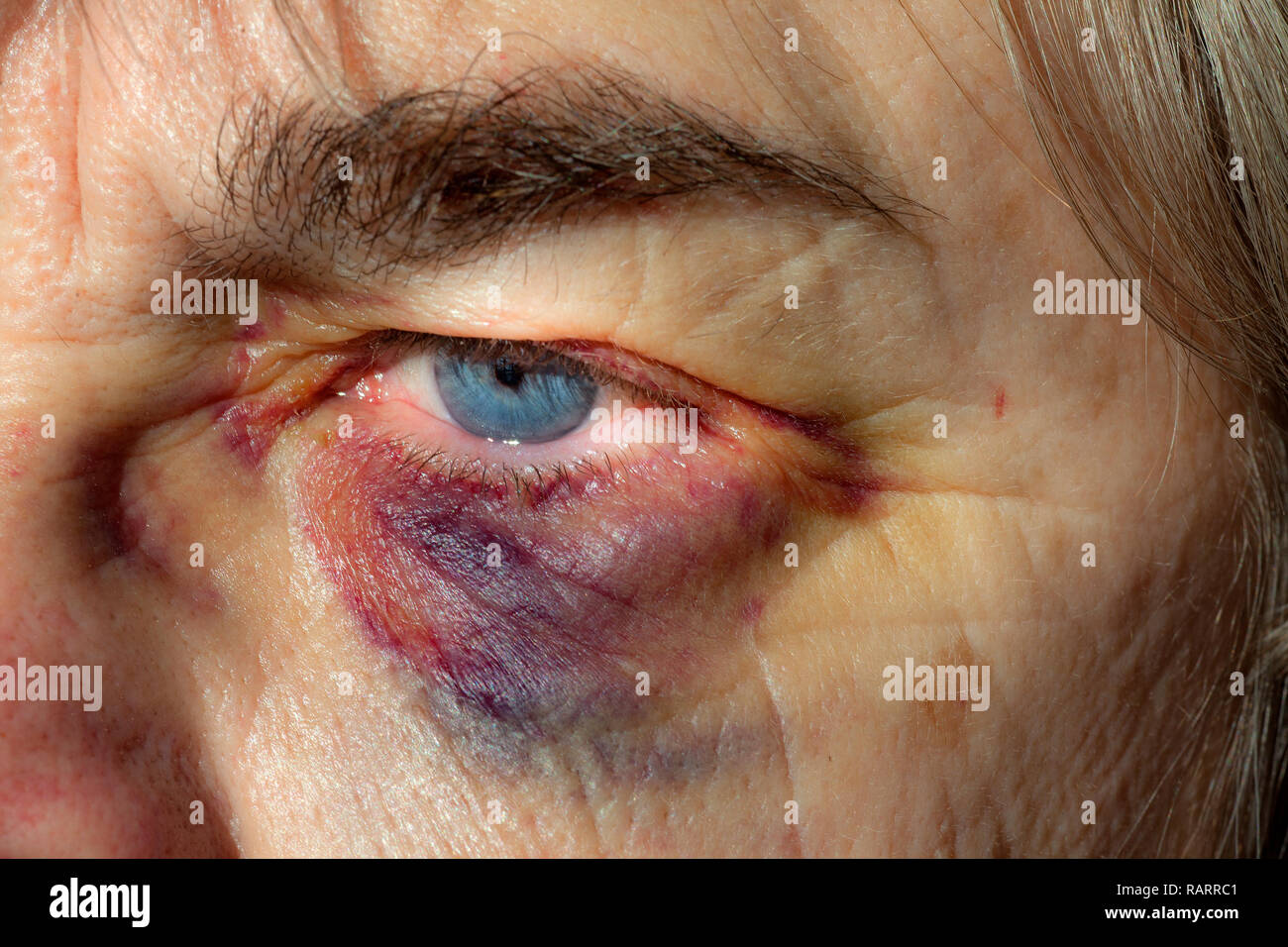 Woman with a black eye also called a periorbital hematoma. Stock Photo
