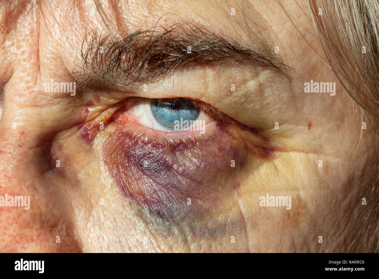 Closeup of a woman with a black eye. Stock Photo