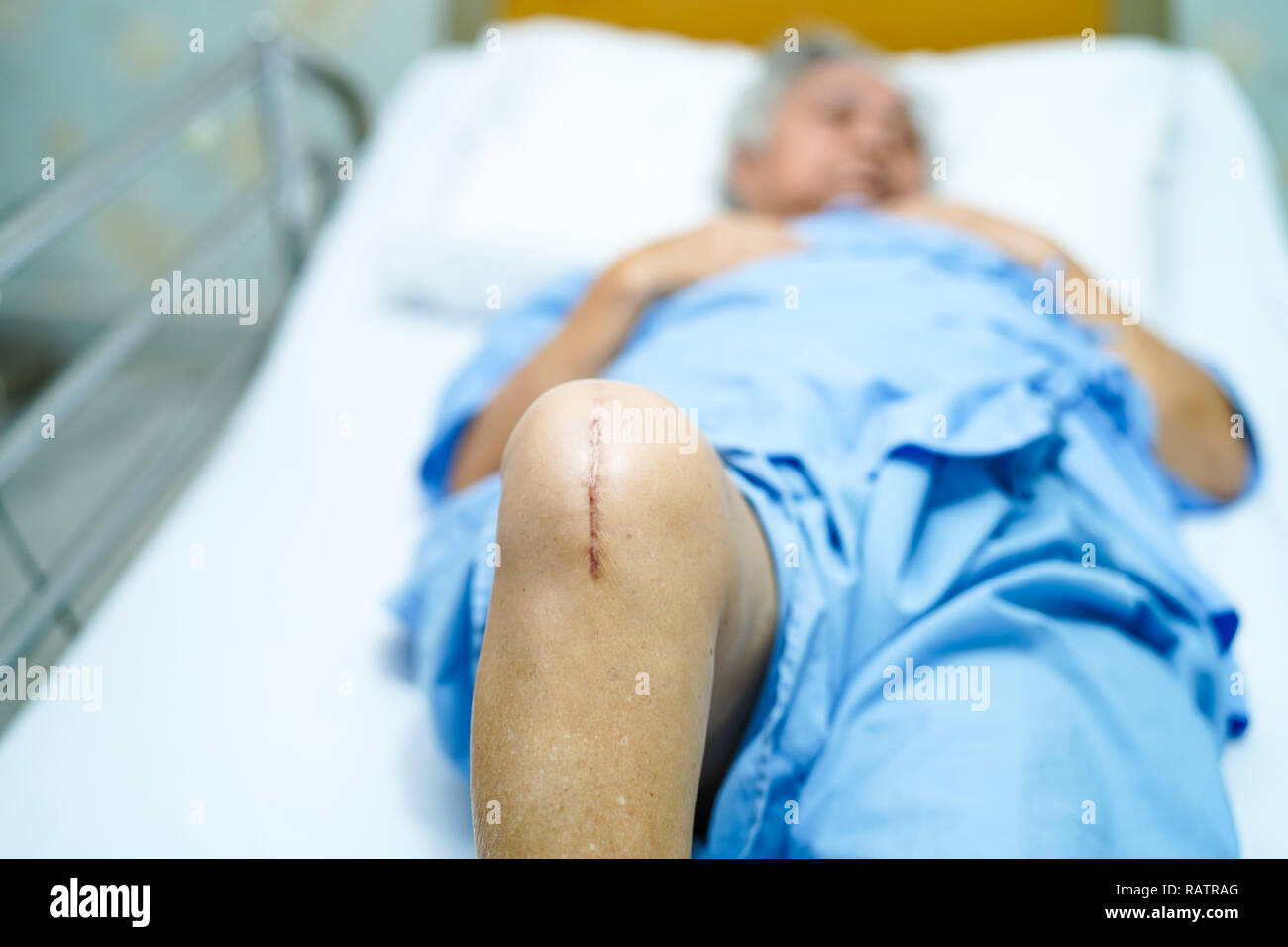 Asian senior or elderly old lady woman patient show her scars surgical total knee joint replacement Suture wound surgery arthroplasty on bed. Stock Photo