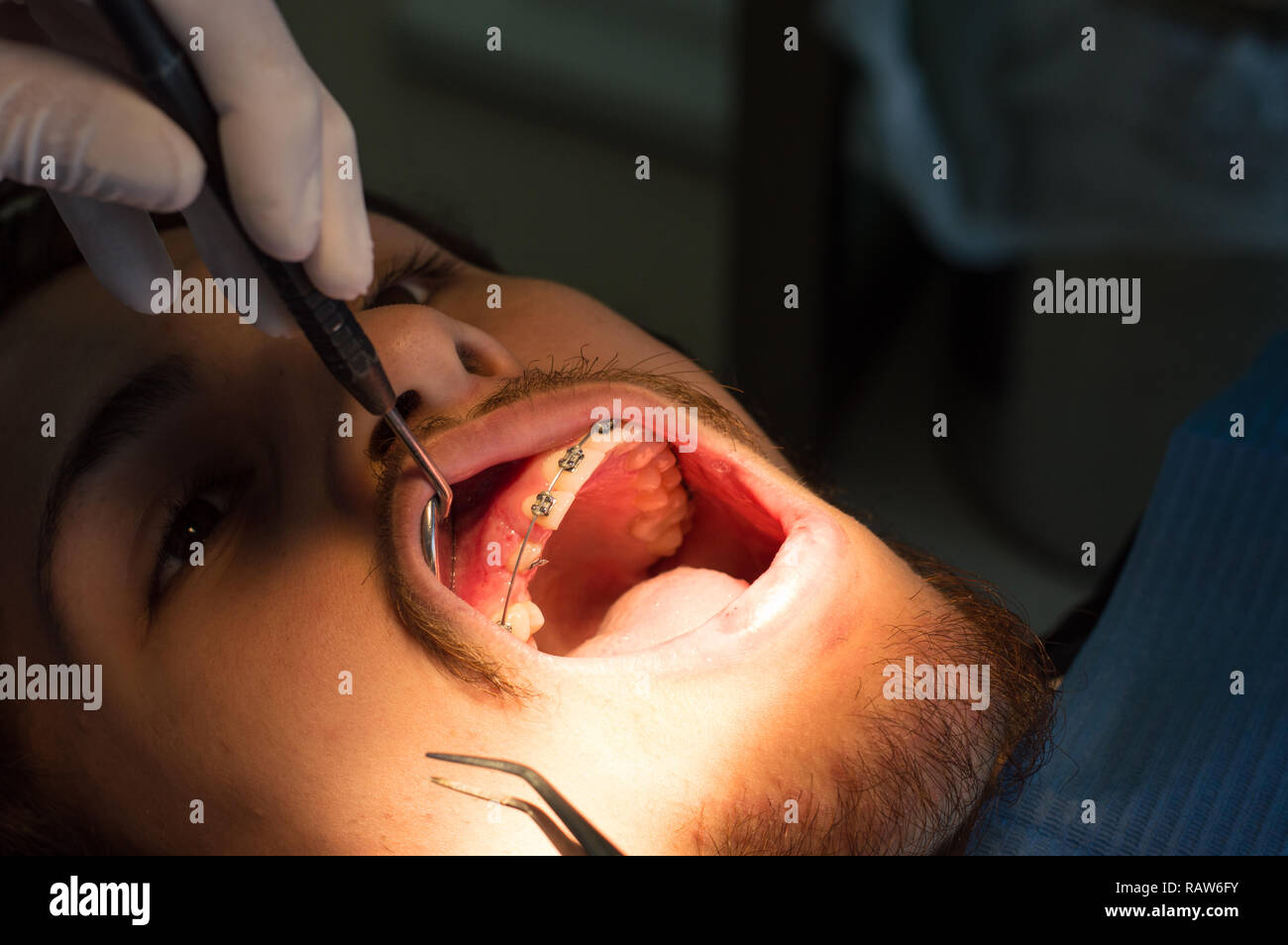 Orthodontics Procedure. Exposure of unerupted, impacted tooth. Stock Photo