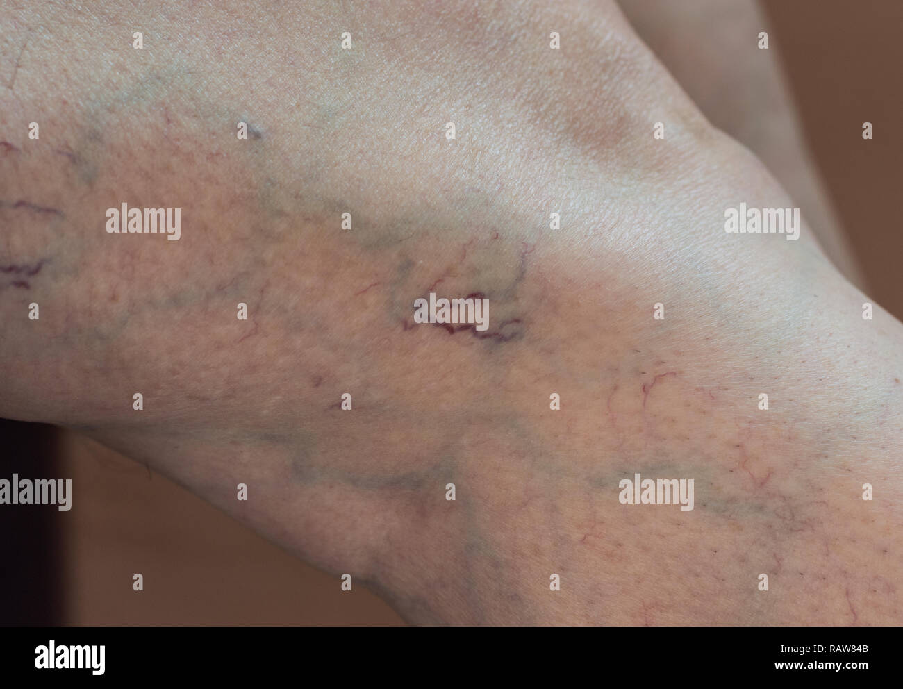 Varices, Spider veins on a woman's leg. Stock Photo