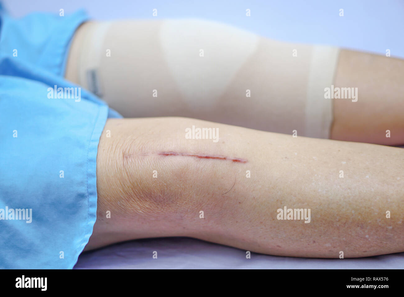 Asian senior or elderly old lady woman patient show her scars surgical total knee joint replacement Suture wound surgery arthroplasty in hospital. Stock Photo
