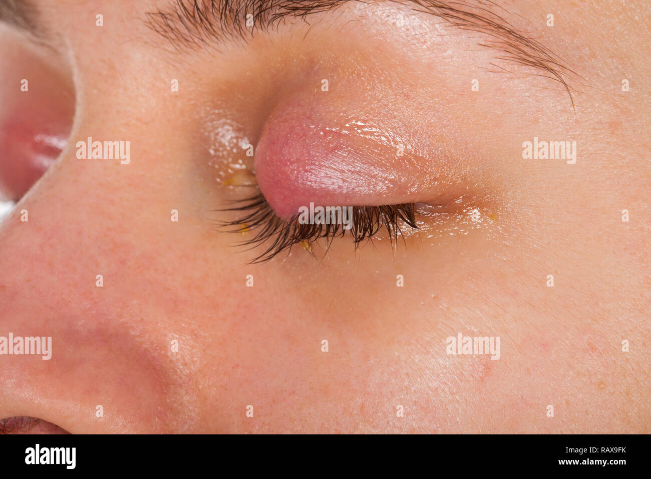 Close up picture of upper eyelid inflammation - chalazion - young female suffering from viral infection Stock Photo