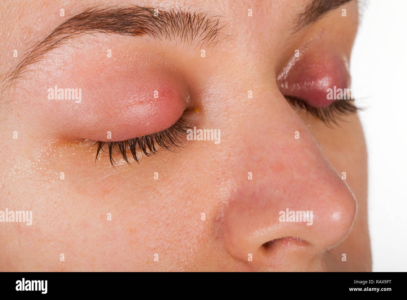 Close up picture of upper eyelid inflammation - chalazion - young female suffering from viral infection Stock Photo