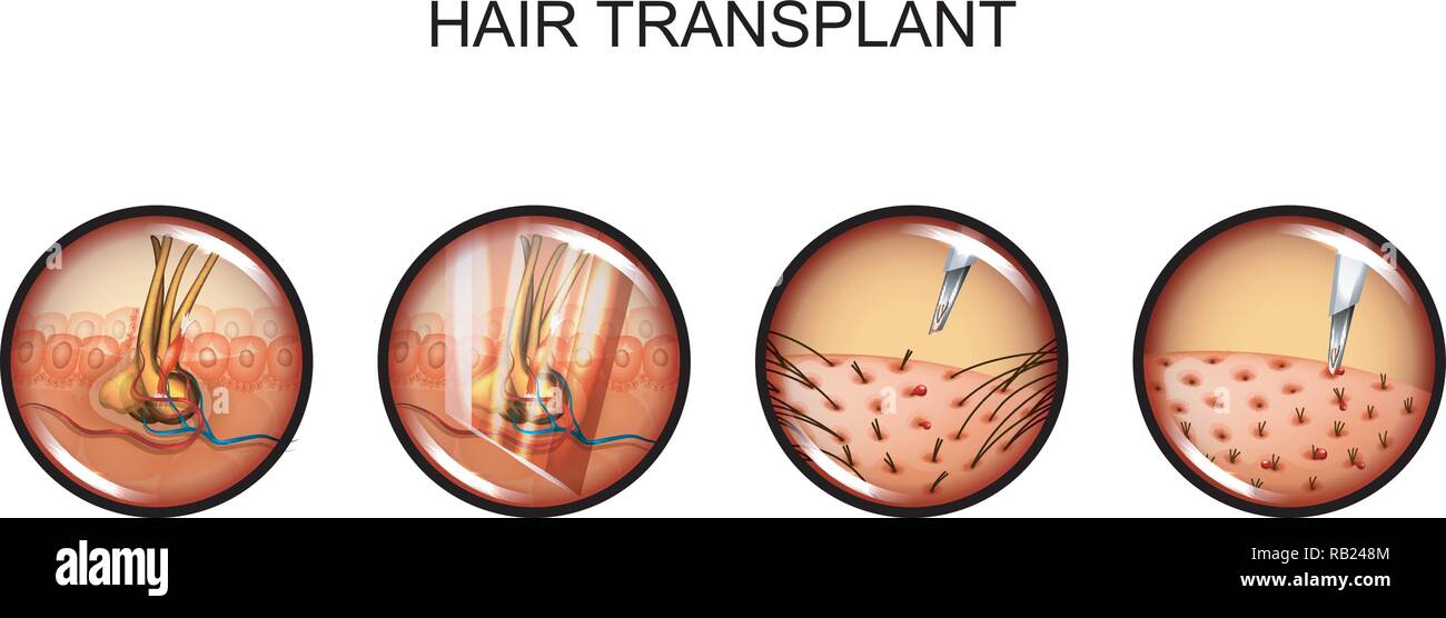 vector illustration of hair transplantation. head. alopecia Stock Vector