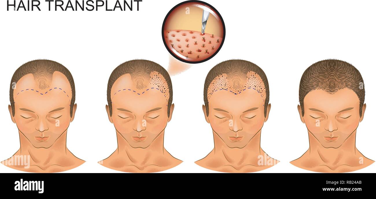 vector illustration of the process of hair transplantation of the occipital part of the head Stock Vector