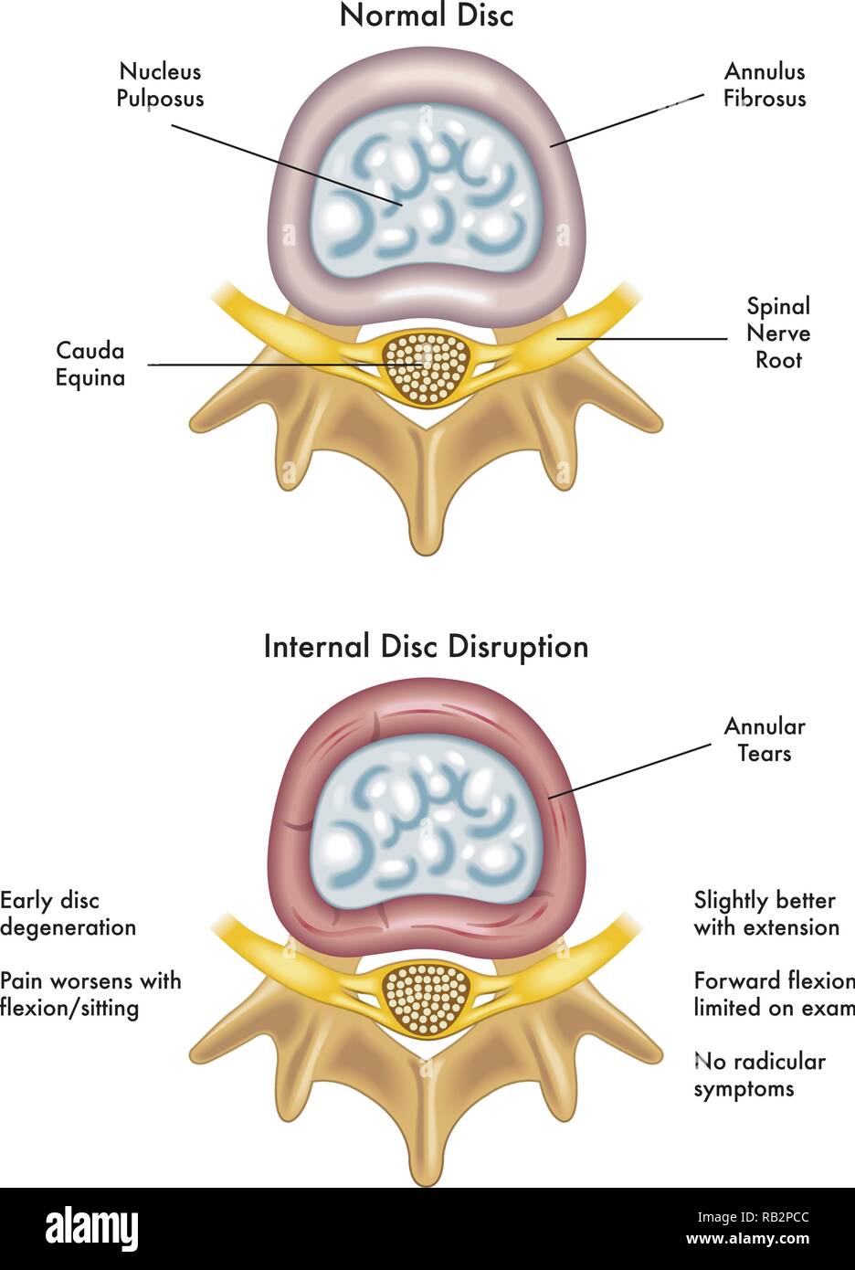 Medical illustration of the effects of internal disruption disc Stock Vector