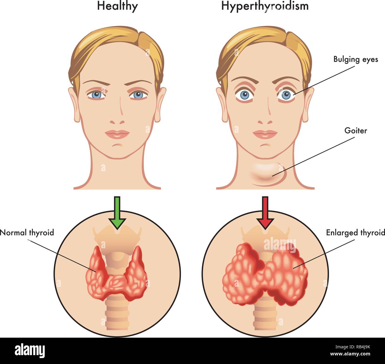 Hyperthyroidism symptoms