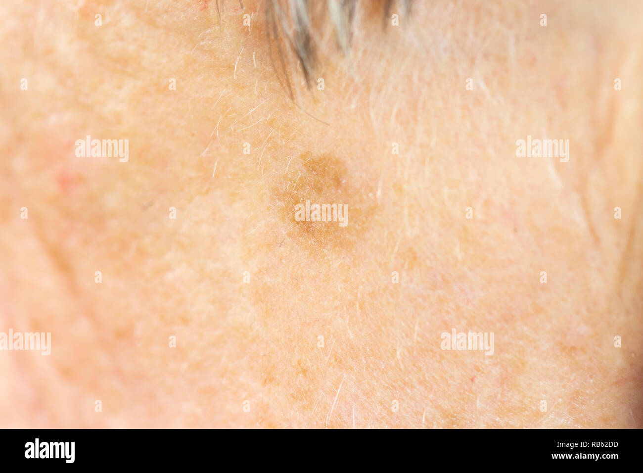 Old Age Spot High Resolution Stock Photography And Images Alamy