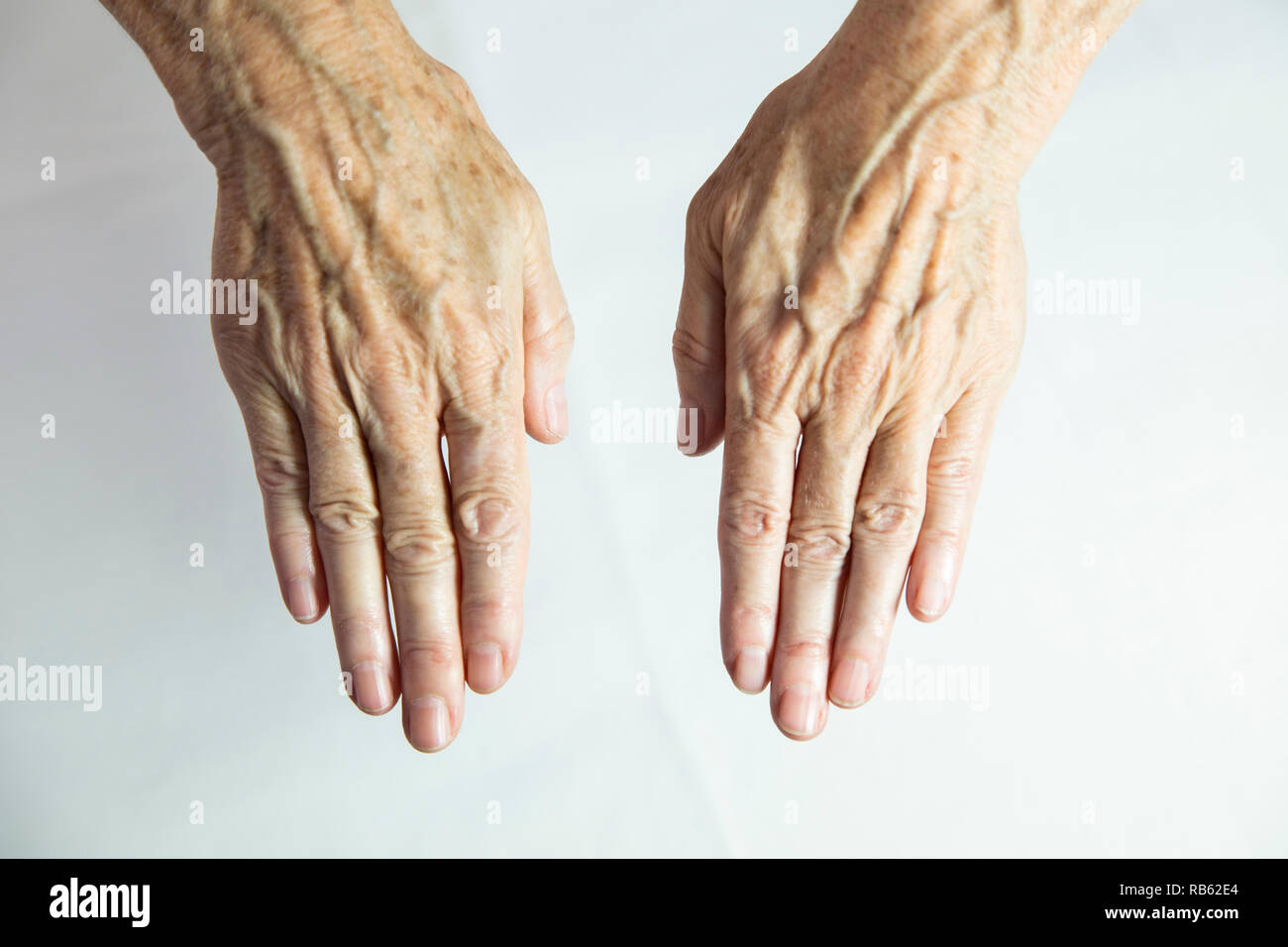 Age Spots Hands High Resolution Stock Photography And Images Alamy