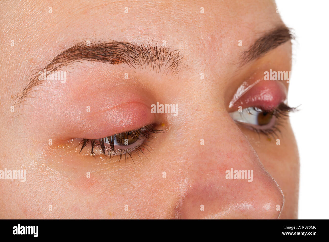 Sty on eyelid hires stock photography and images Alamy