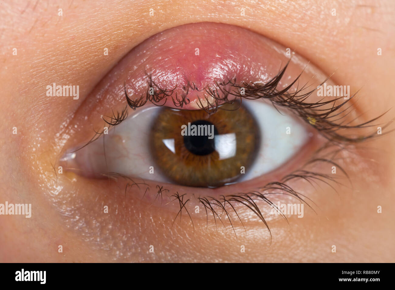 Pus Abscess Stock Photos Pus Abscess Stock Images Alamy