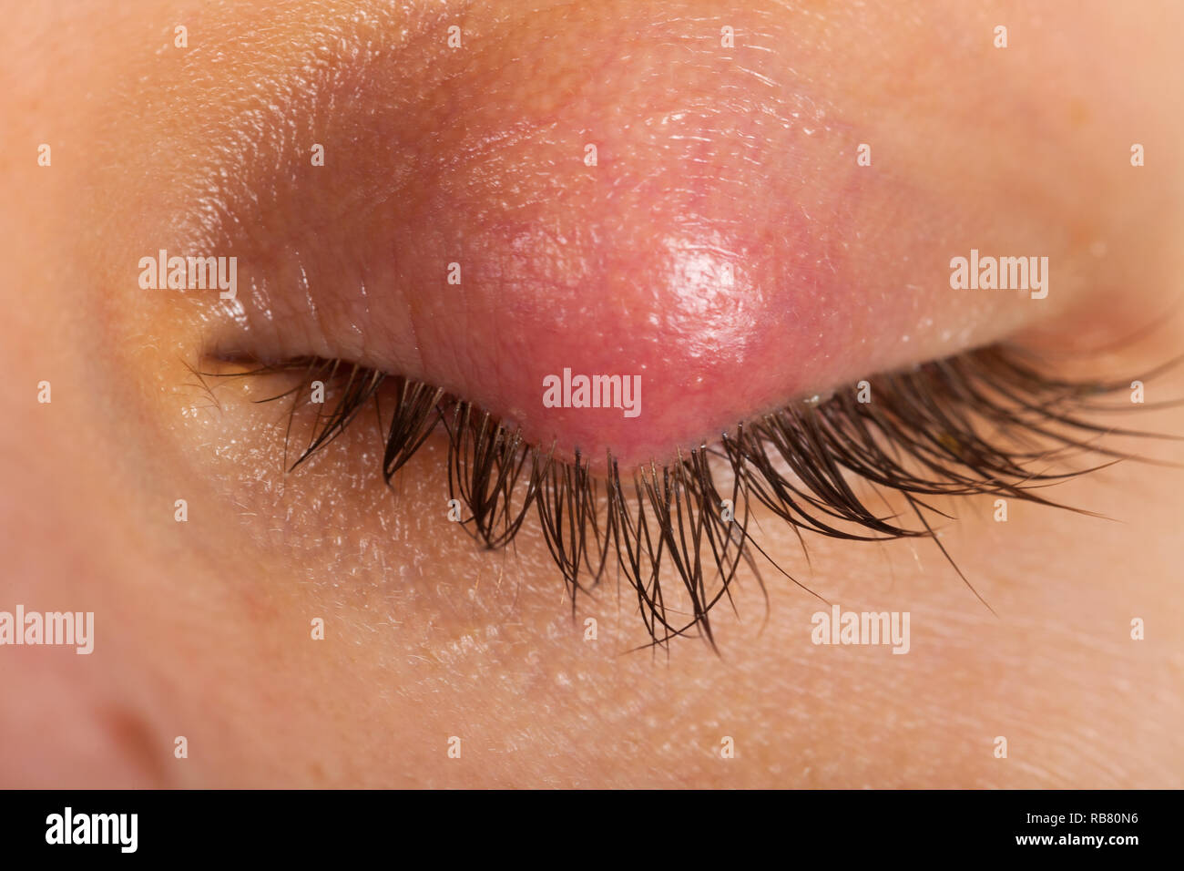 Close up picture of female patient's infected eye. Hordeolum on upper